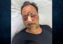 Κρήτη: Παραμένει στο νοσοκομείο με προβλήματα όρασης ο Ελληνοκαναδός που ξυλοκοπήθηκε άγρια